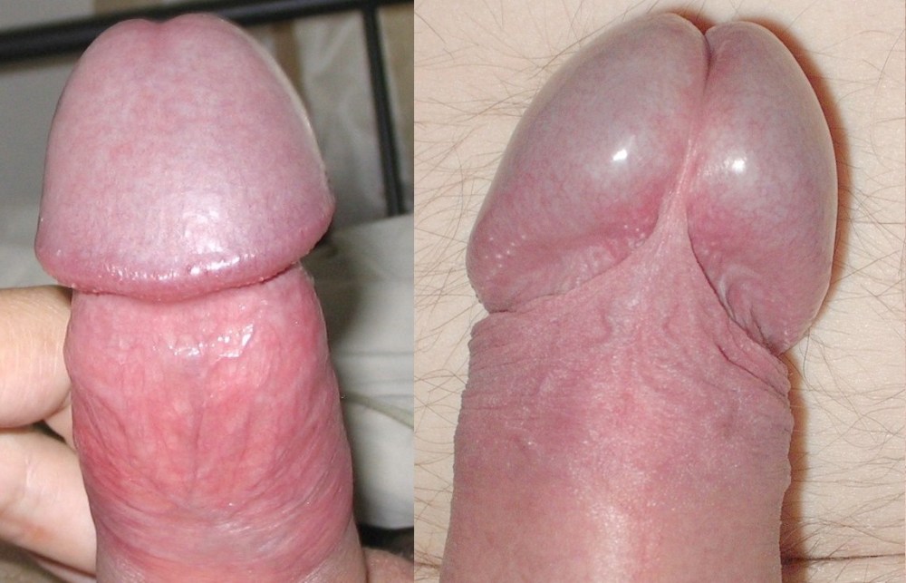 Головка полового органа