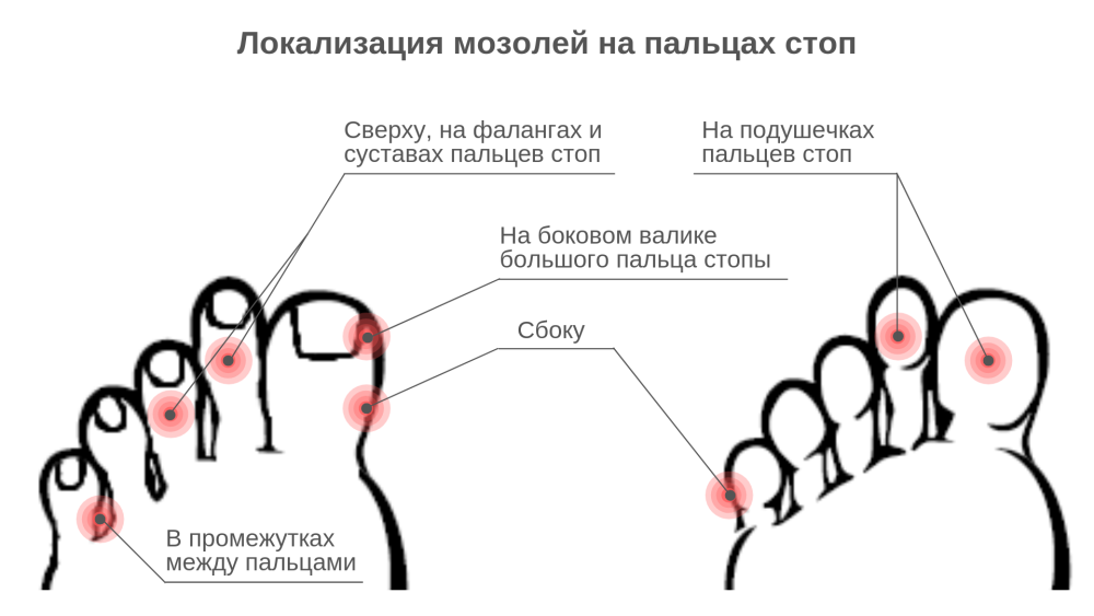 Мозоль между пальцев ног